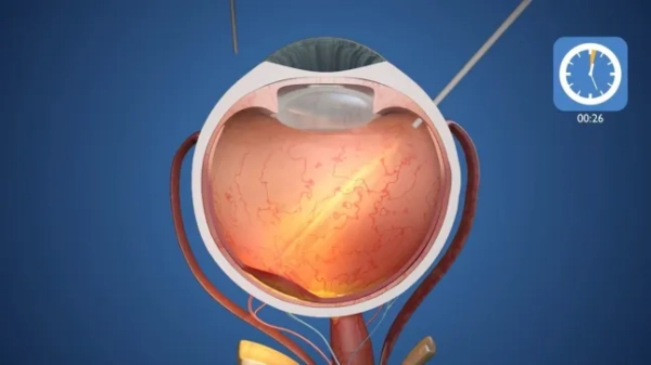 Конкурент Ілона Маска створює революційний очний чіп, який вперше у світі відновлює зір